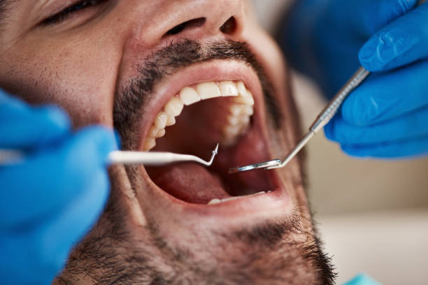 Best Emergency Treatment for Oral Infections in Escondido, CA